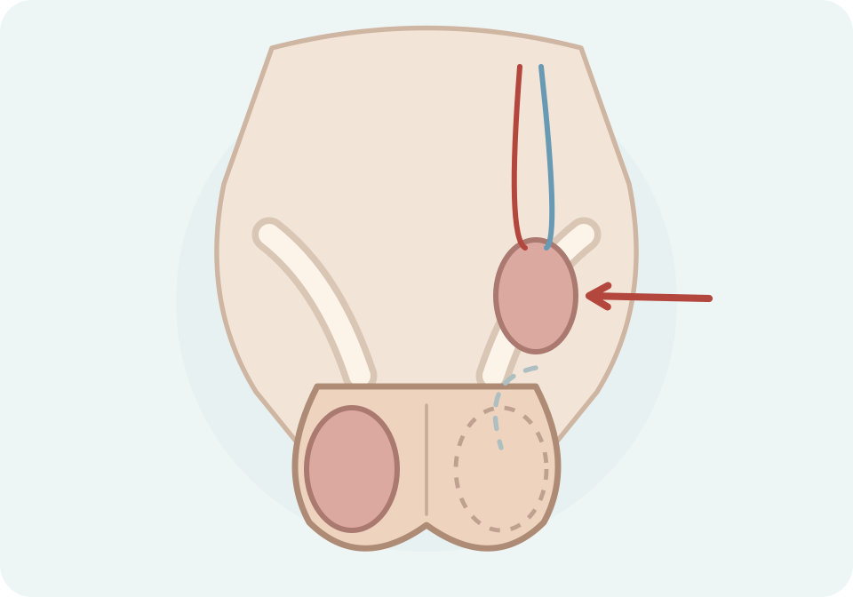 Exemple unilateral de testicle retingut al canal inguinal, amb l’hemiescrot corresponent buit.