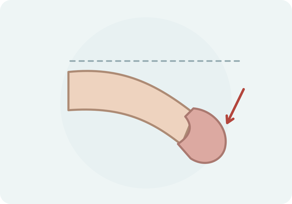 Vista lateral d’un penis amb curvatura ventral, comparat amb un eix recte de referència discontinu.