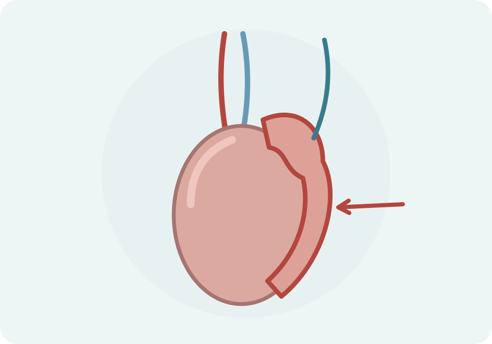 Epidídim engruixit i vermell al costat d’un testicle d’aspecte conservat.