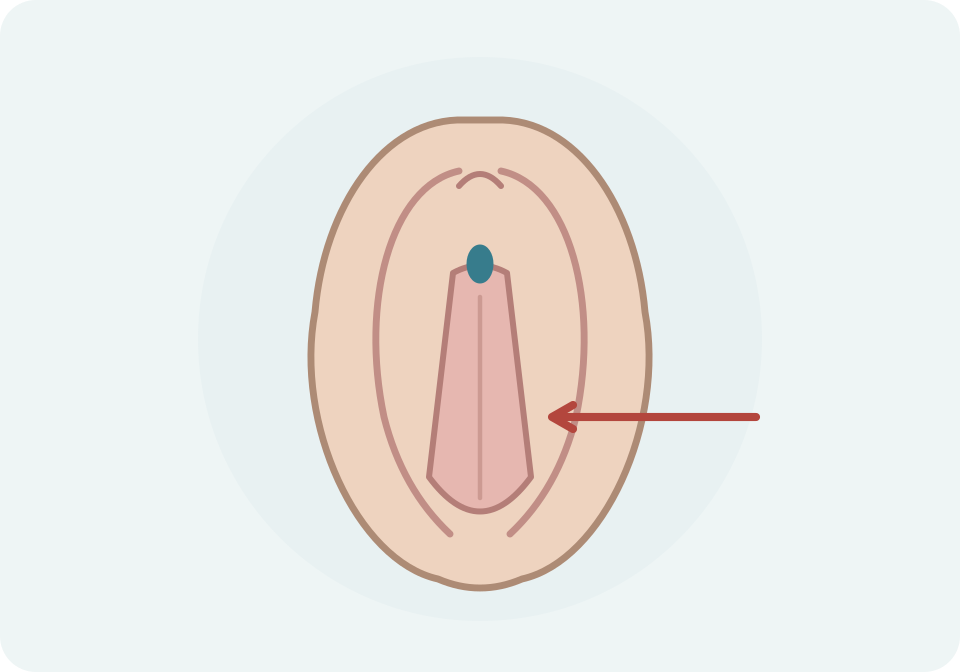 Vista frontal de la vulva amb fusió parcial dels llavis menors i una petita obertura anterior conservada.