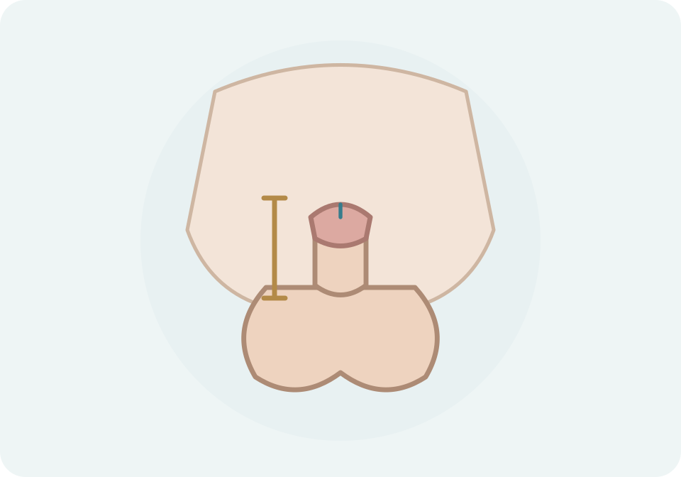 Exemple esquemàtic de penis petit amb una marca de mesura, sense escala numèrica ni límits diagnòstics.