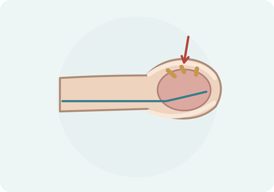 Tall esquemàtic amb zones d’adherència entre la cara interna del prepuci i el gland.