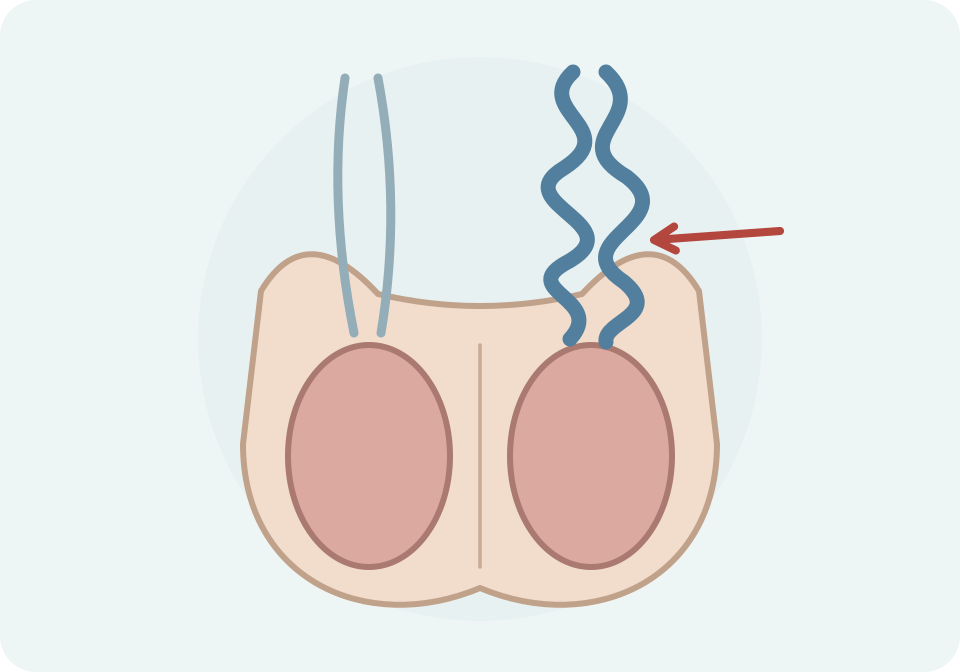Esquema frontal amb un grup de venes dilatades al cordó espermàtic esquerre del pacient, sobre el testicle.