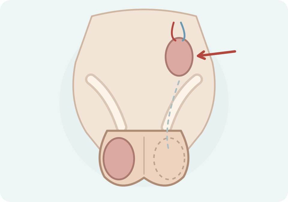 Exemple unilateral de testicle intraabdominal, una de les possibles causes d’un testicle no palpable, amb l’hemiescrot buit.