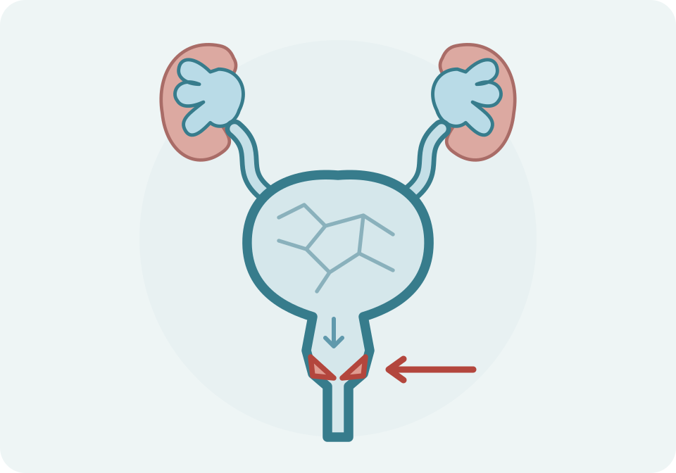 Esquema de vàlvules d’uretra posterior, amb membrana obstructiva assenyalada, dilatació de la uretra proximal, bufeta de paret engruixida i vies urinàries superiors dilatades.