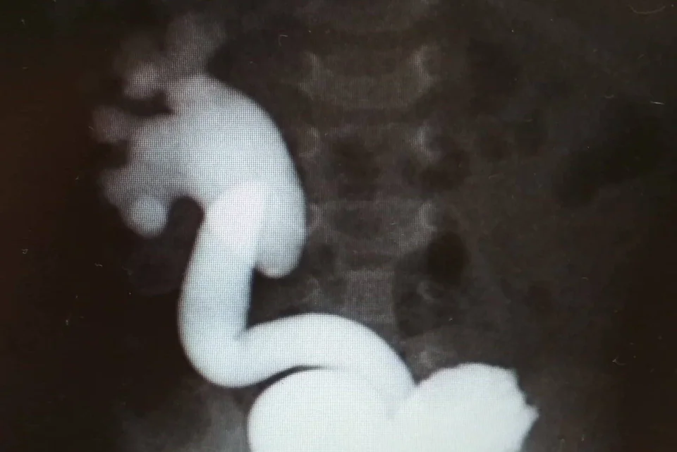 Reflux vesicorenal