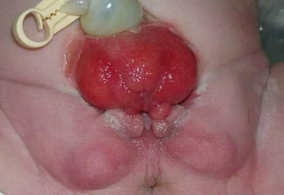 Extròfia vesical