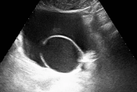Ureterocele