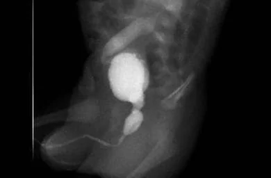 Vàlvules d’uretra posterior