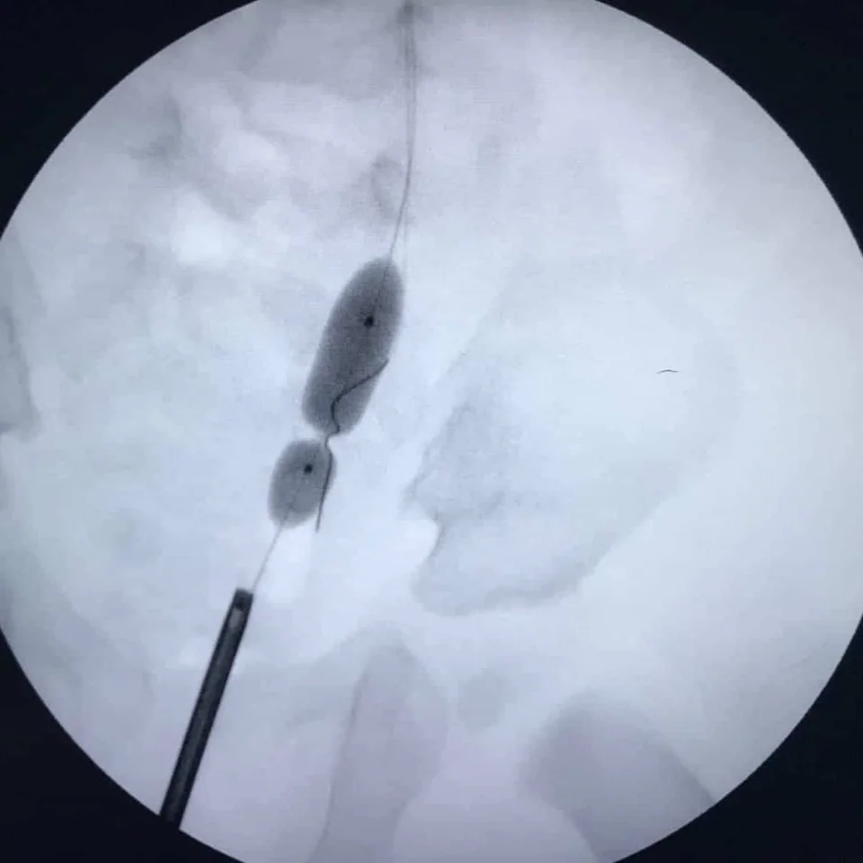 Tractament endoscòpic del megaurèter obstructiu
