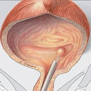 Tractament endoscòpic del reflux vesicoureteral