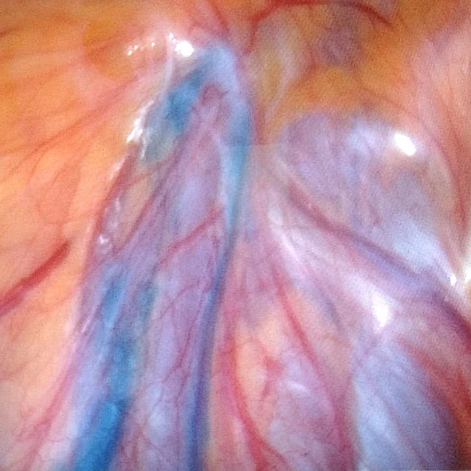 Varicocele laparoscòpic