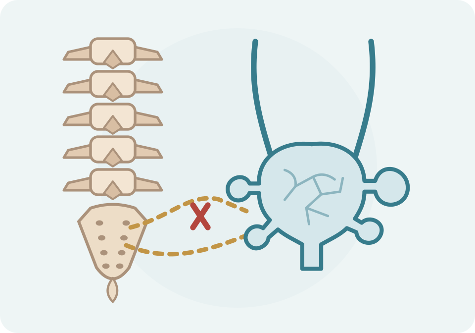 Columna lumbar amb vèrtebres i sacre recognoscibles, senyal nerviós interromput i exemple de bufeta petita, piriforme i multidiverticular.